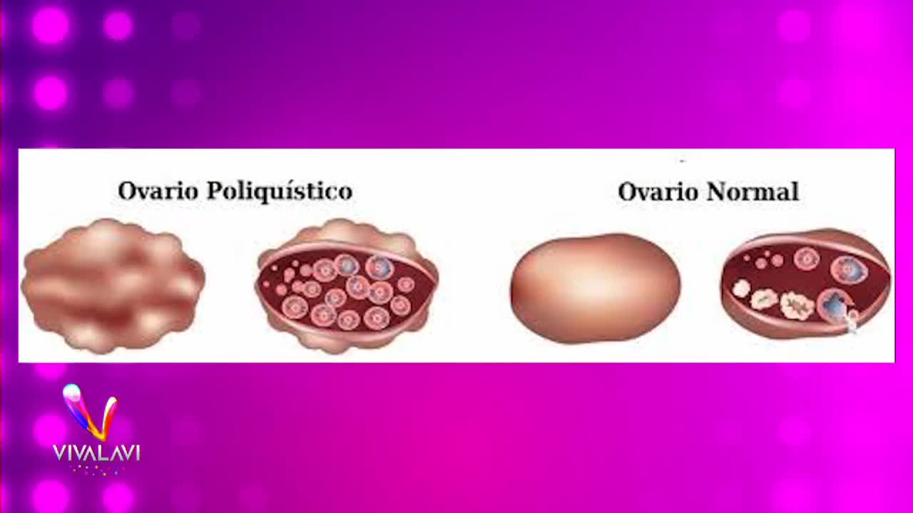 Así se ve el ovario poliquístico.