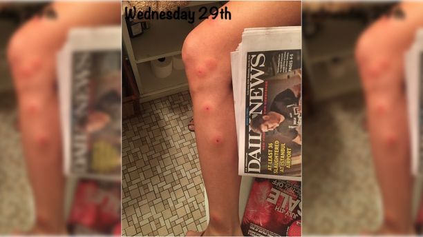 Así quedó esta modelo luego de ser "atacada" por chinches en hotel (FOTOS)