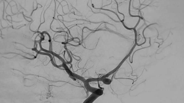 Sufre derrame cerebral mientras recibía sexo oral