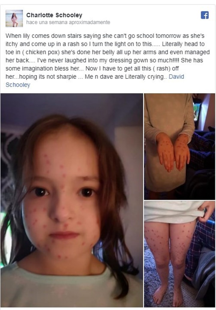 Niña intenta evadir examen y se pinta puntitos rojos en el cuerpo: dijo que tenía varicela