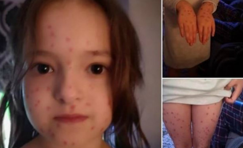 Niña intenta evadir examen y se pinta puntitos rojos en el cuerpo: dijo que tenía varicela