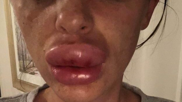 Así quedó la boca de una mujer tras asisitir a una fiesta de bótox 