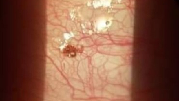 Hombre va al doctor por molestia en el ojo; era una garrapata