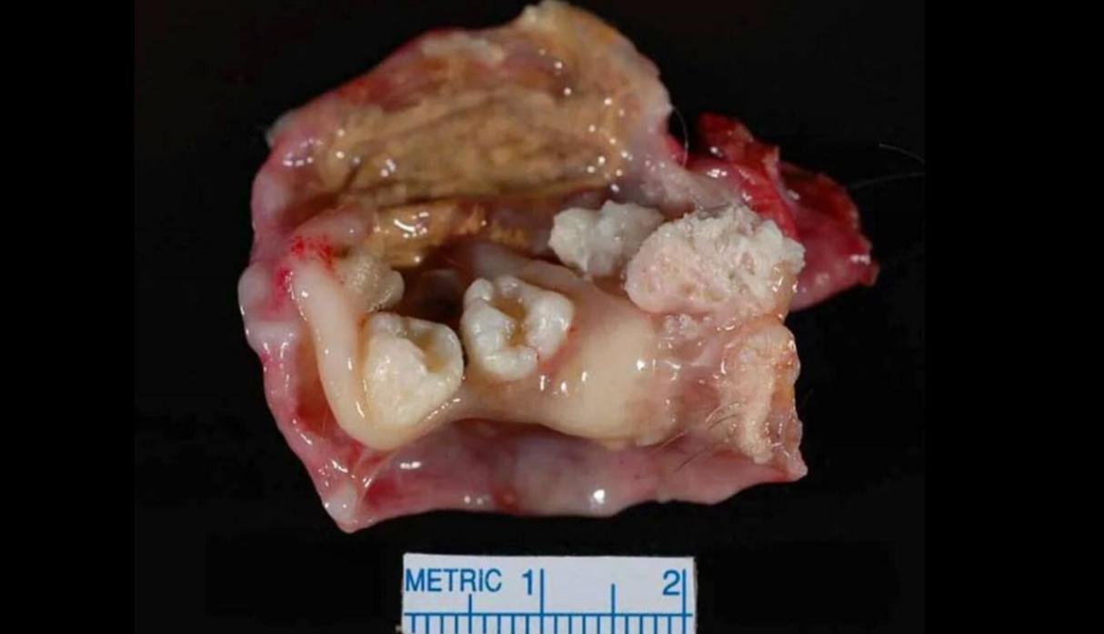 ¿Qué es un Teratoma? Todo sobre el extraño tumor con pelos, dientes y ojos