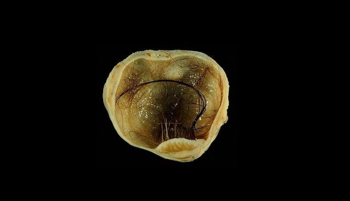 ¿Qué es un Teratoma? Todo sobre el extraño tumor con pelos, dientes y ojos