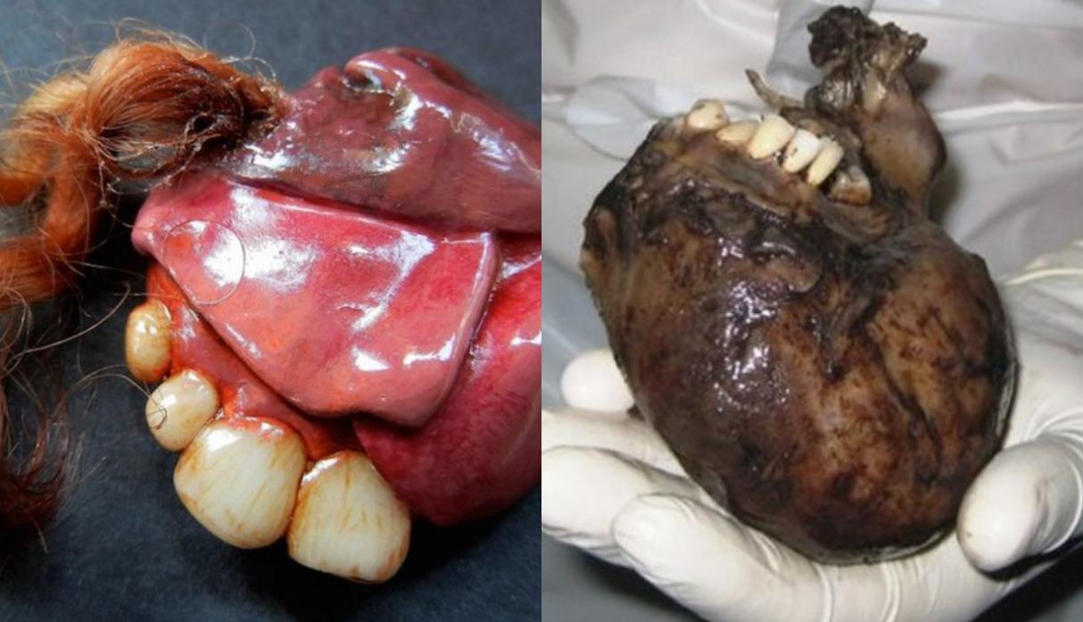¿Qué es un Teratoma? Todo sobre el extraño tumor con pelos, dientes y ojos