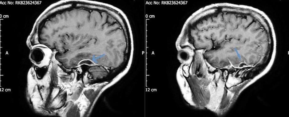 ¿Usas cotonetes para limpiar tus oídos? Podría ser peligroso