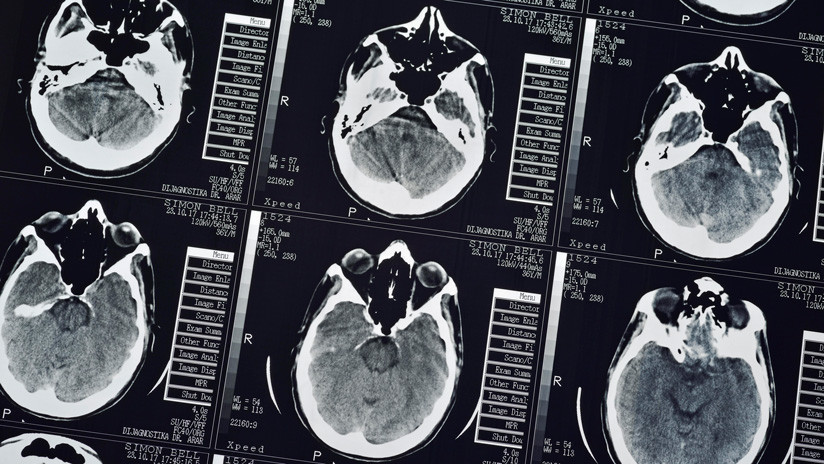 Hombre come carne cruda y le encuentran más de 700 gusanos en el cerebro y pulmones