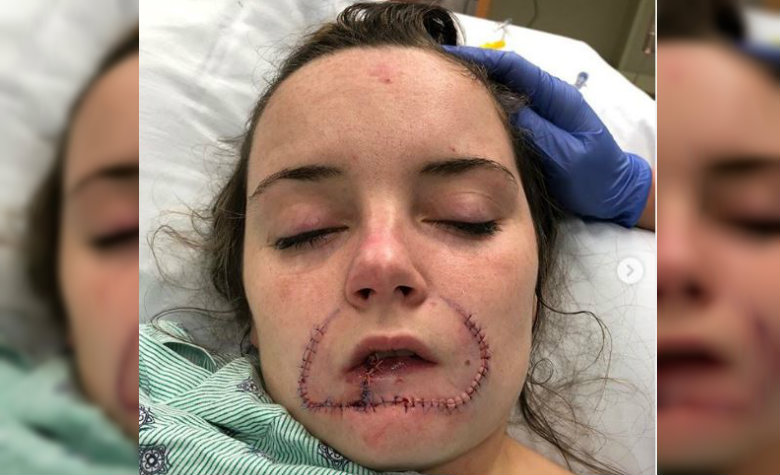 mordida del labio interior