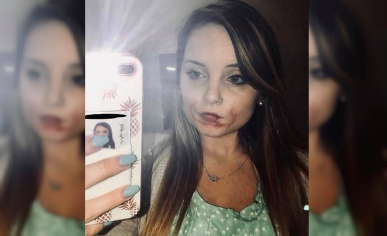 mordida del labio interior