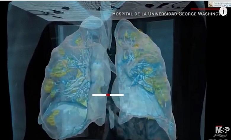 Video muestra cómo ataca el COVID-19 a los pulmones