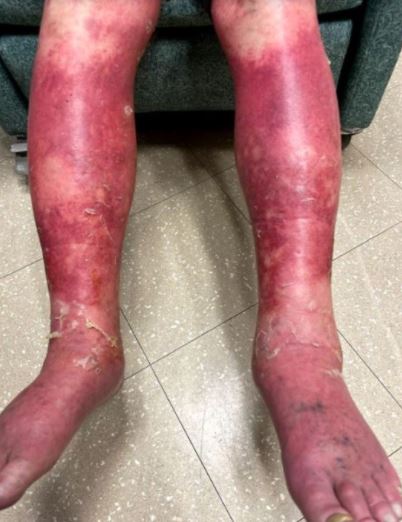 Hombre sufre erupción en su piel tras recibir vacuna contra COVID-19