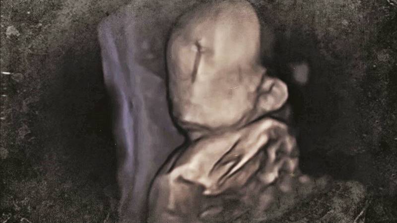 Bebé que nació sin ojos y nariz cumple su primer año de vida