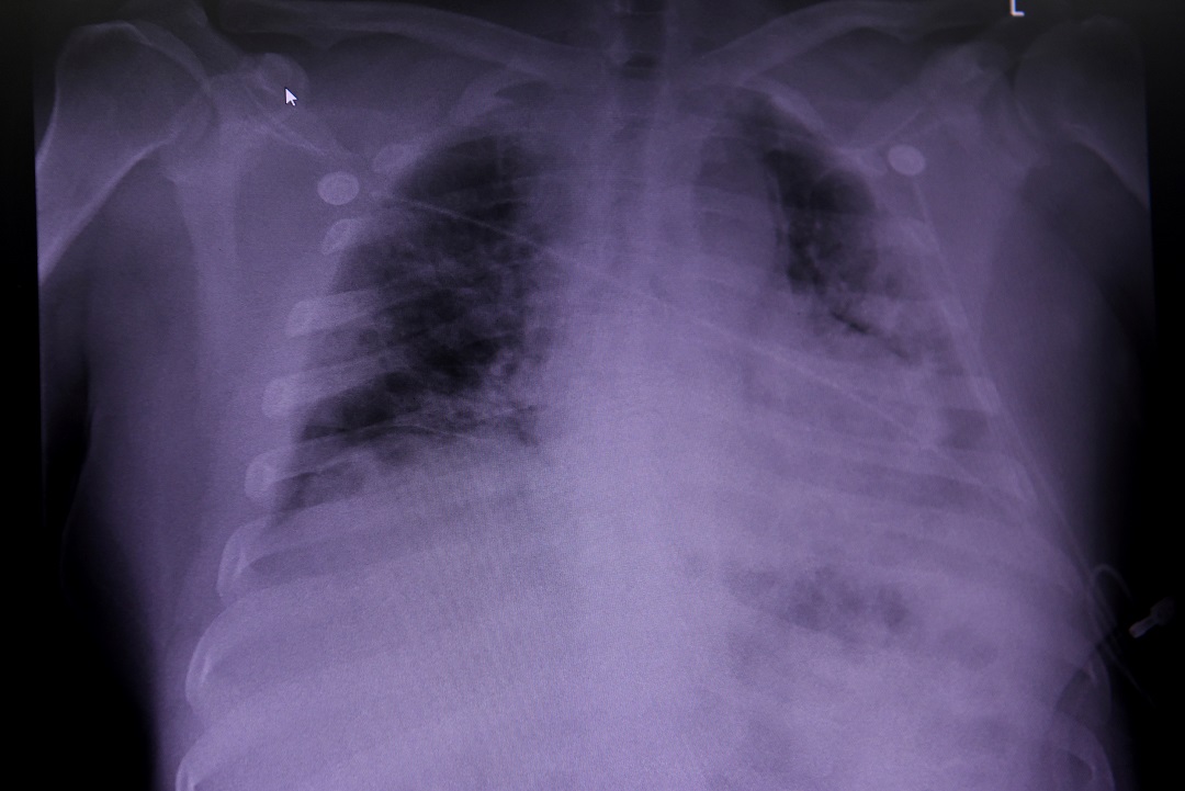Daño pulmonar encontrado en fallecidos por coronavirus ayuda a entender el "Covid prolongado": estudio