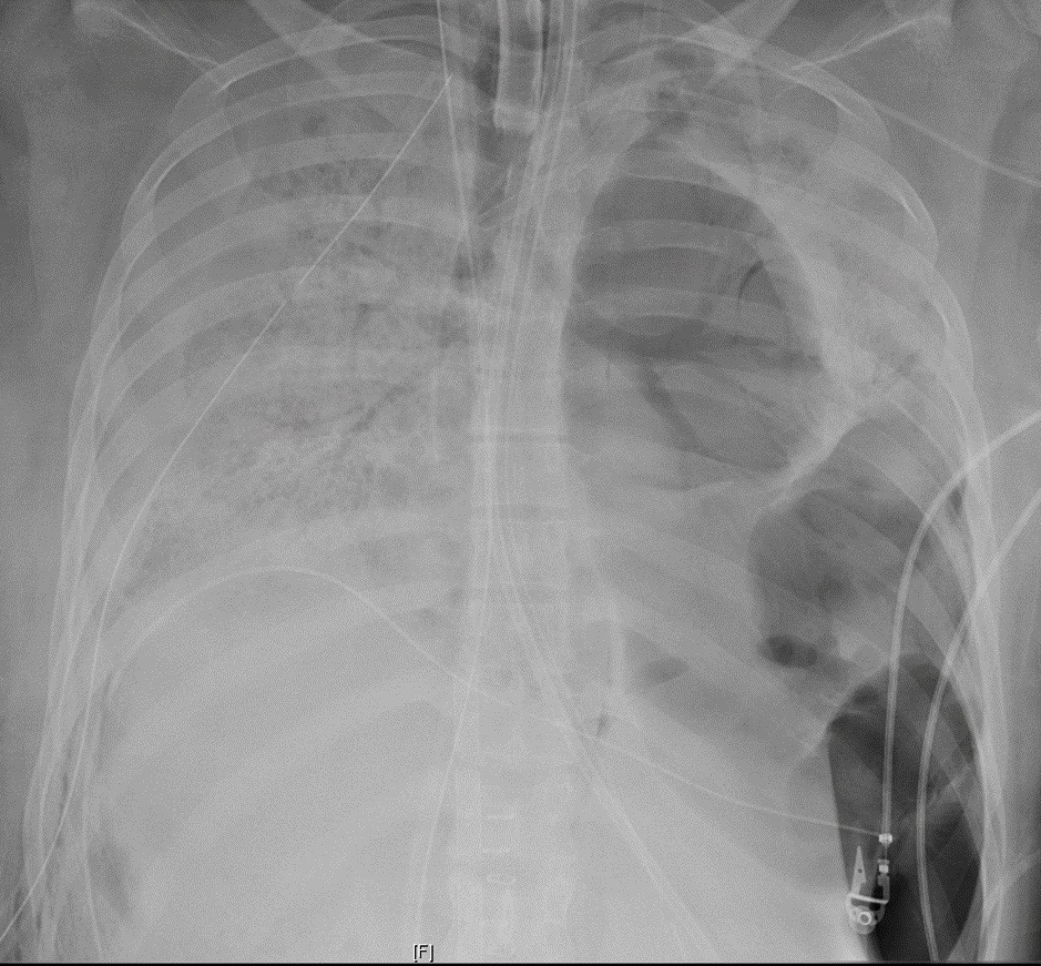 Así puede dejar tus pulmones el coronavirus