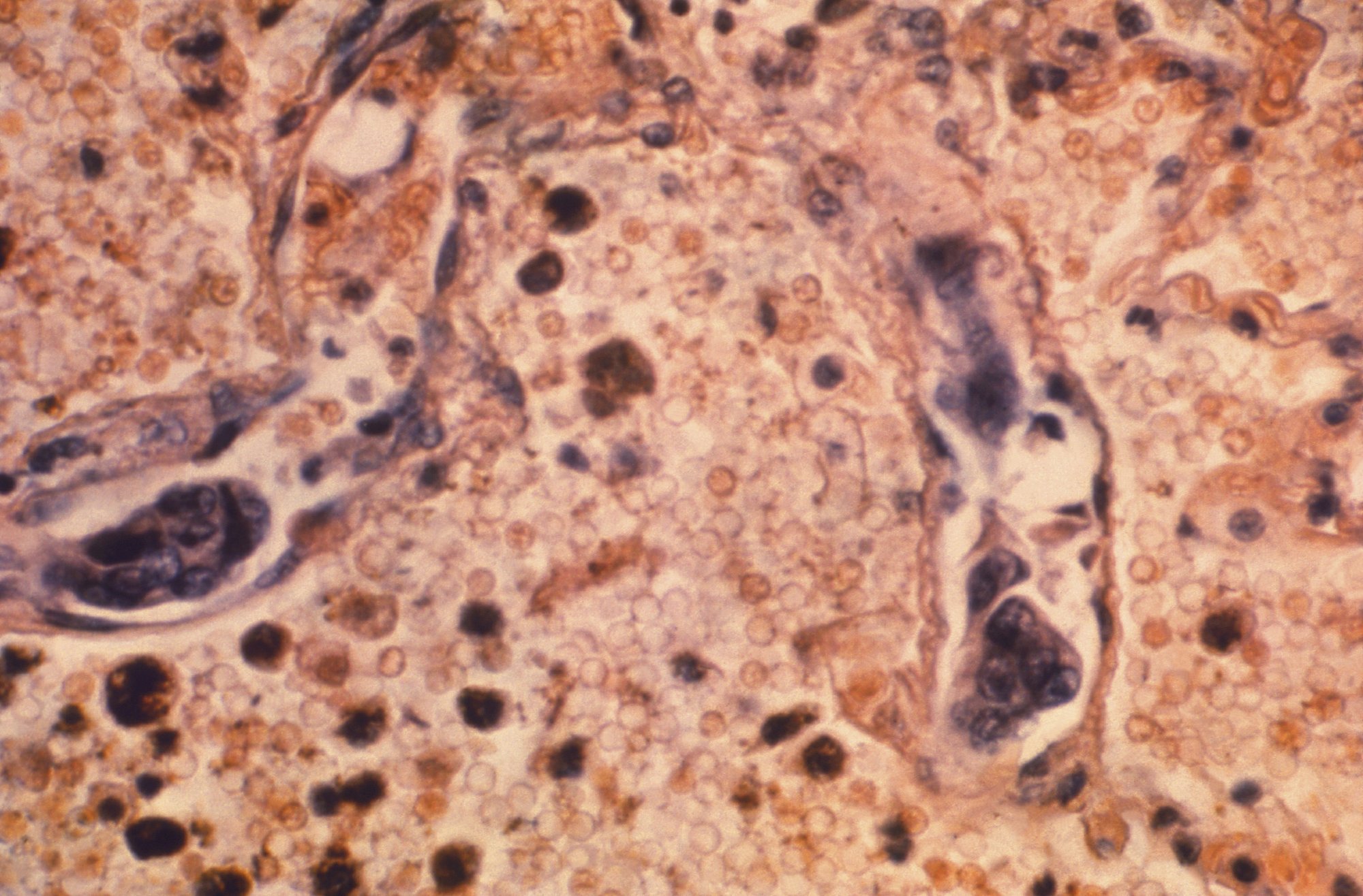 Muertes por cáncer registran caída récord en EU