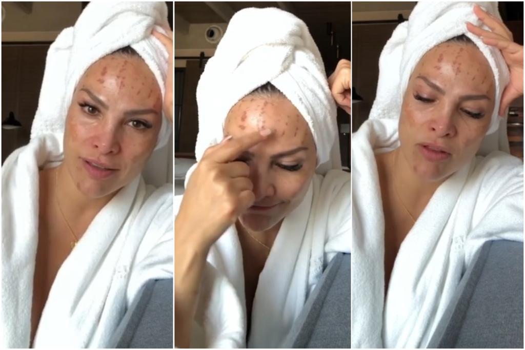 Mi piel ya no aguantó: Muestra Fabiola Campomanes heridas en su rostro tras tratamiento