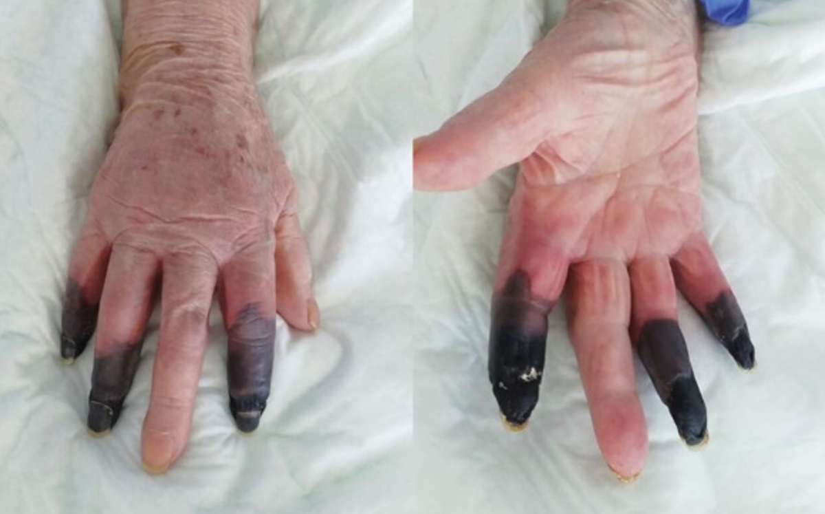 COVID-19 provoca gangrena en dedos de mujer de la tercera edad