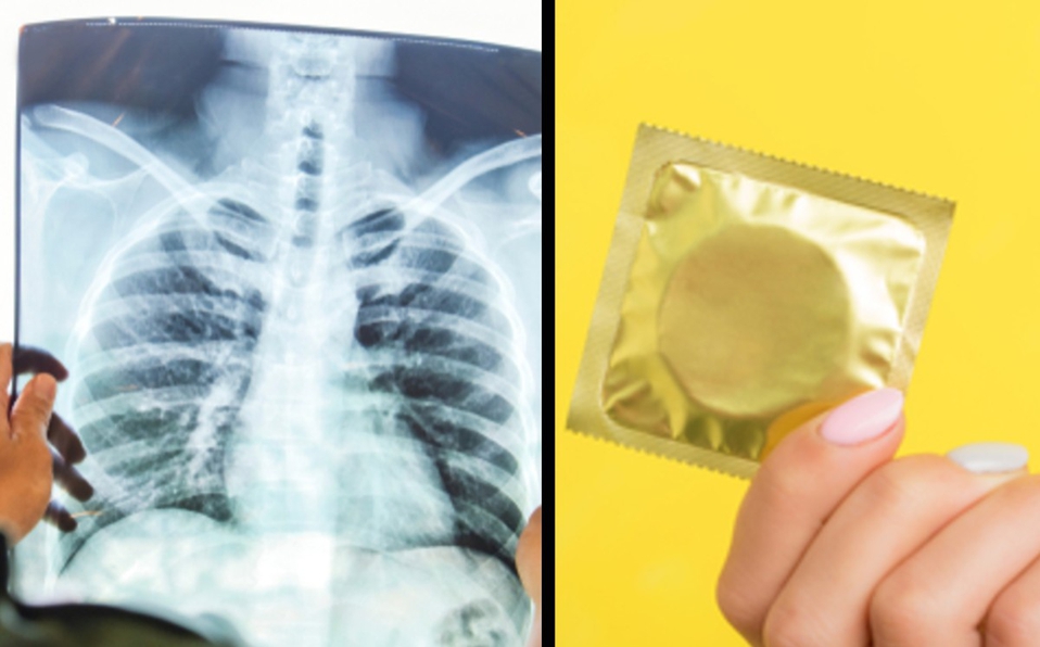 ¡Mal diagnóstico! Tratan a la mujer contra tuberculosis... tenía un condón en el pulmón
 