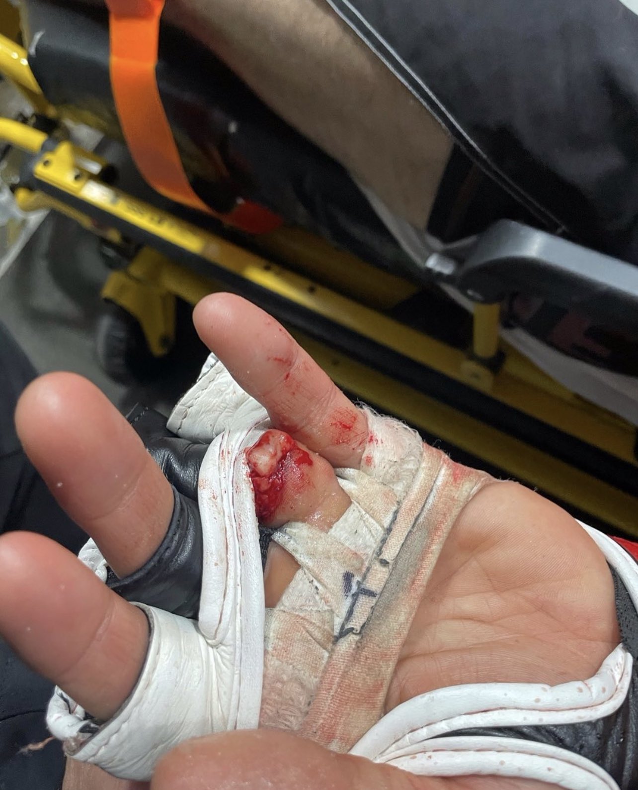Peleador de artes marciales mixtas pierde su dedo durante combate