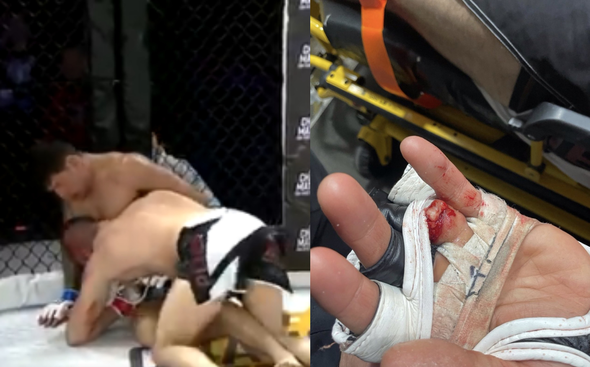 Peleador de artes marciales mixtas pierde su dedo durante combate