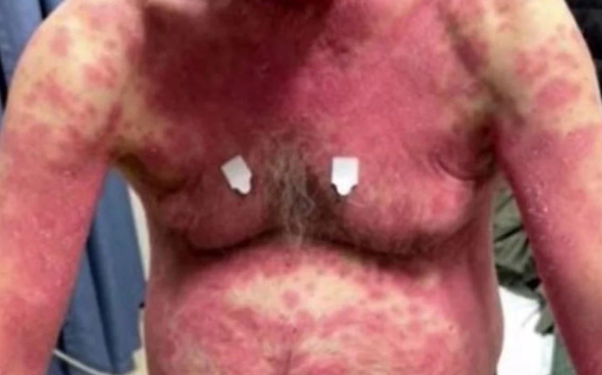 Hombre sufre erupción en su piel tras recibir vacuna contra COVID-19