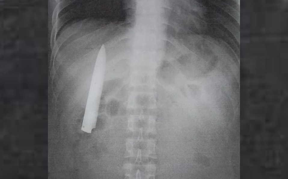 Hombre descubre hoja de cuchillo en cuerpo a un año de ser apuñalado; caso viral
