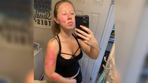 Queman rostro a turista con bebida flameante en Cancún