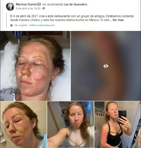 Mujer sufre quemaduras en rostro tras flamear trago en Cancún