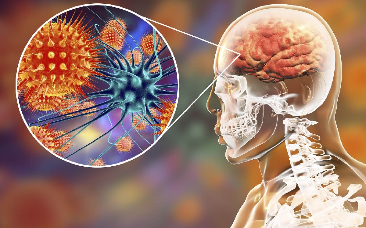 12 datos que debes de saber sobre la meningitis