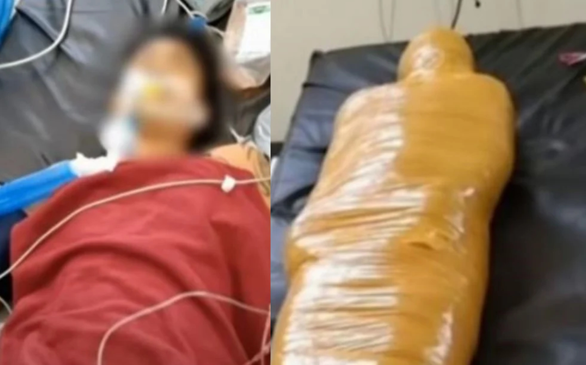 Hospital confunde a paciente al creer que murió por covid-19 y lo envuelven con cinta de embalaje “como una momia”