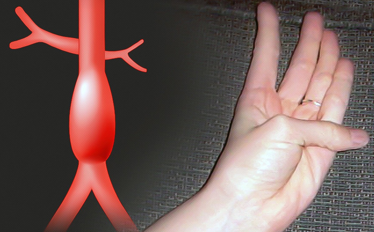 Un solo dedo nos puede revelar si padecemos una condición cardiovascular grave