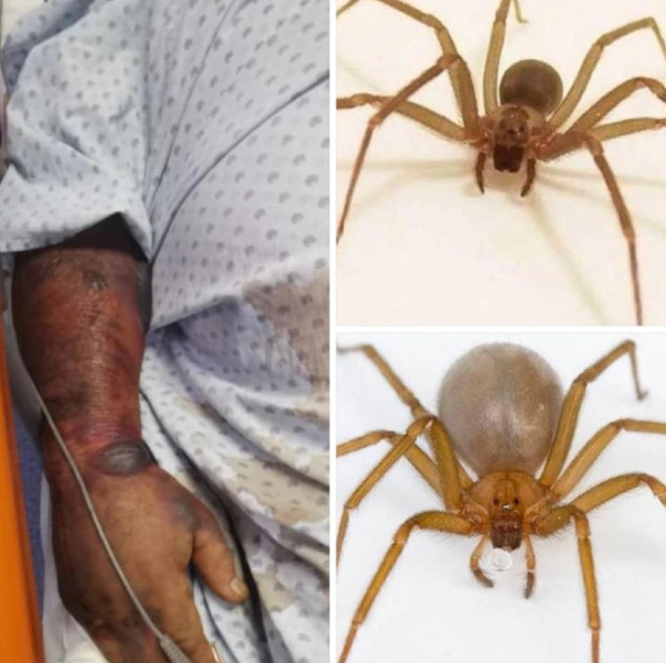 Hombre muere tras picadura de araña violinista; llevaba una semana hospitalizado