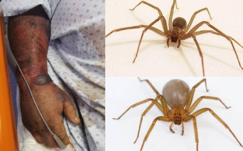 Muere hombre por mordida de araña violinista en Salvatierra