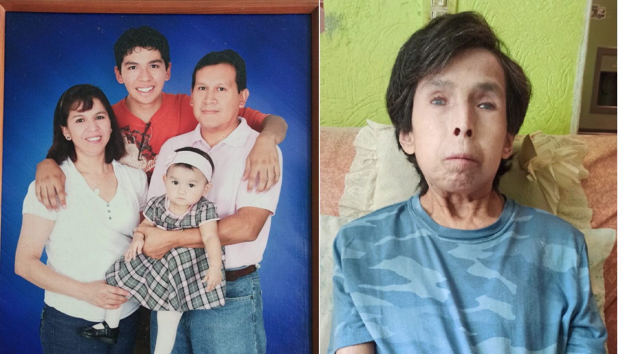 Esclerosis sistémica: la enfermedad autoinmune que cambió la vida de Catalina