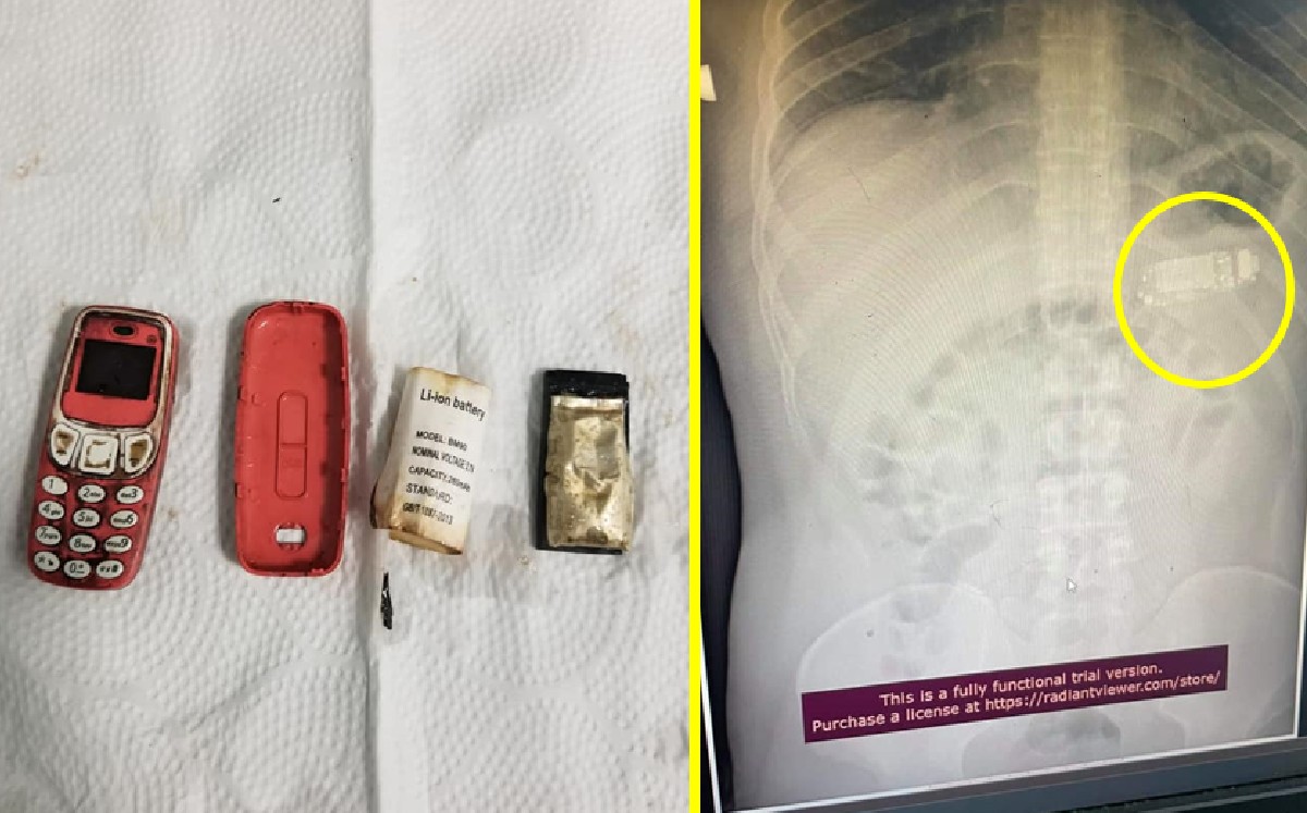 Hombre se traga un celular y médicos lo extraen sin abrirle el estómago