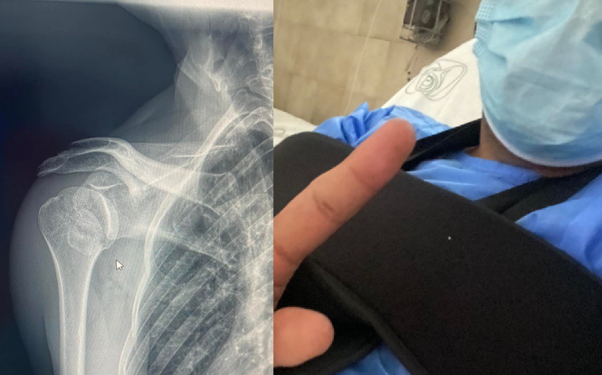 "Mi brazo está muriendo": maestro lagunero pide ayuda para costosa operación