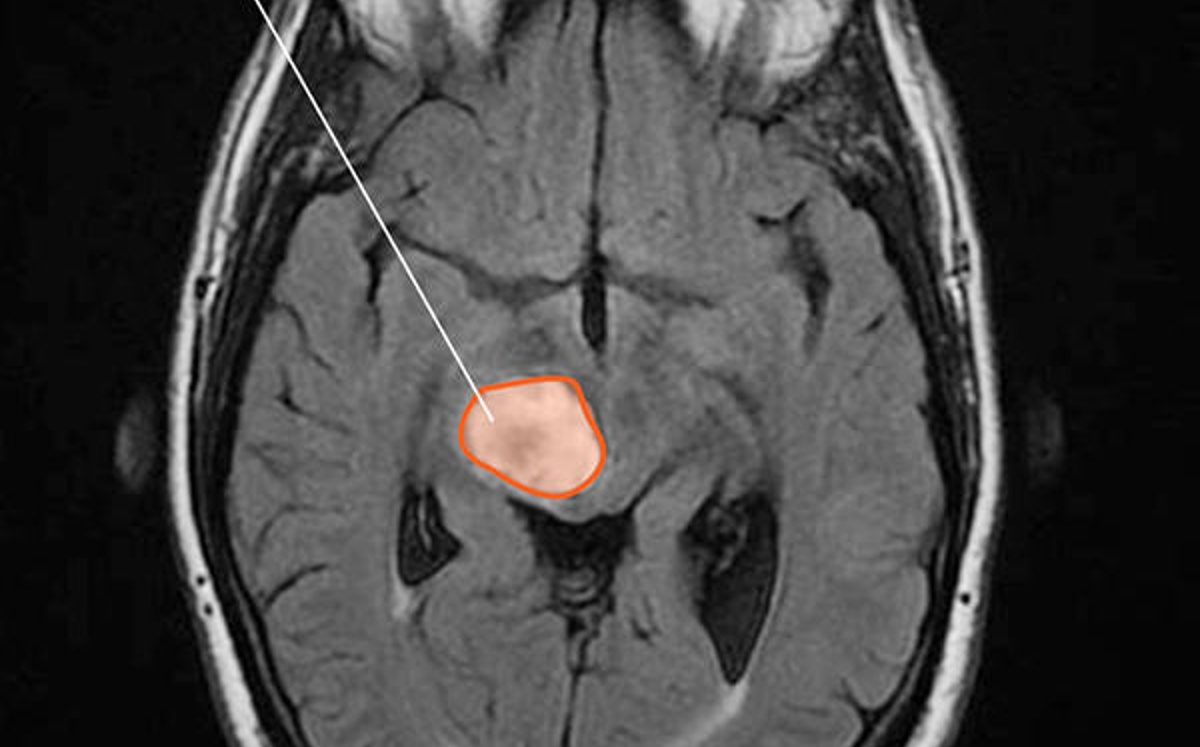 Glioma difuso intrínseco de tronco / NCI - Connect