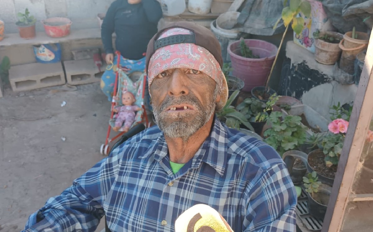 Torreón. Piden apoyo para tragafuegos que sufrió accidente