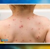 Autoridades en todo México han exhortado a la población a vacunar a sus hijos contra el sarampión para evitar consecuencias fatales.