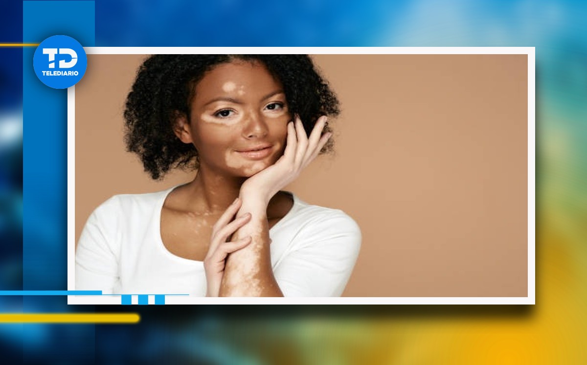 El vitiligo es una enfermedad que no pone en riesgo la vida ni es contagiosa.