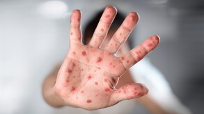 En México, se han registrado 10 contagios de viruela del mono en mujeres
