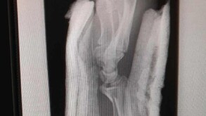 El conductor, identificado como Aarón Ulises Torres, resultó con una fractura en el brazo y fue trasladado de inmediato al Hospital General de Torreón