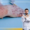Secretaría de Salud asegura que nueva variante de Mpox aún no llega a México. Secretaría de Salud asegura que nueva variante de Mpox aún no llega a México.