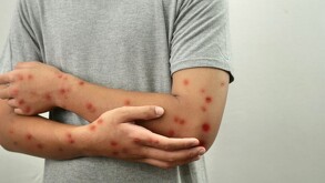 Un joven murió en Cancún por complicaciones asociadas a viruela símica, siendo el primer fallecimiento por esta causa en Quintana Roo en 2025.