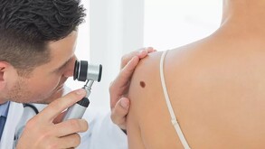 Lunares y el cáncer de piel