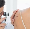 Lunares y el cáncer de piel Lunares y el cáncer de piel