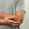 Un joven murió en Cancún por complicaciones asociadas a viruela símica, siendo el primer fallecimiento por esta causa en Quintana Roo en 2025. Un joven murió en Cancún por complicaciones asociadas a viruela símica, siendo el primer fallecimiento por esta causa en Quintana Roo en 2025.