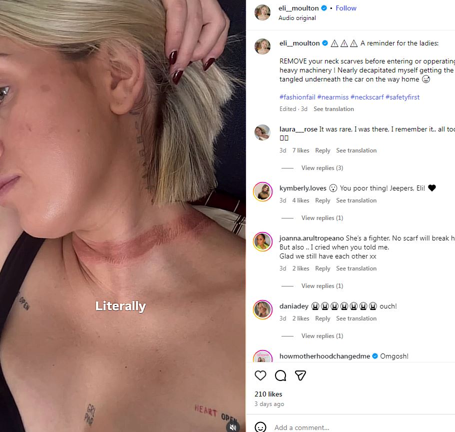Influencer preocupa a sus fans tras sufrir fatal accidente.