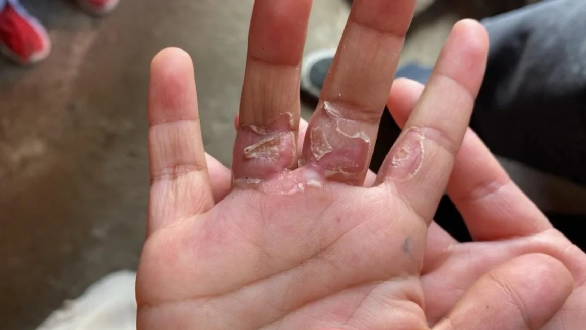 El niño de 4 años acusó que el hombre le quemó las manos en la estufa El niño de 4 años acusó que el hombre le quemó las manos en la estufa